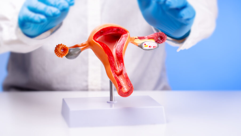 Deep Infiltrating Endometriosis: Symptoms, Diagnosis, and Treatment Options