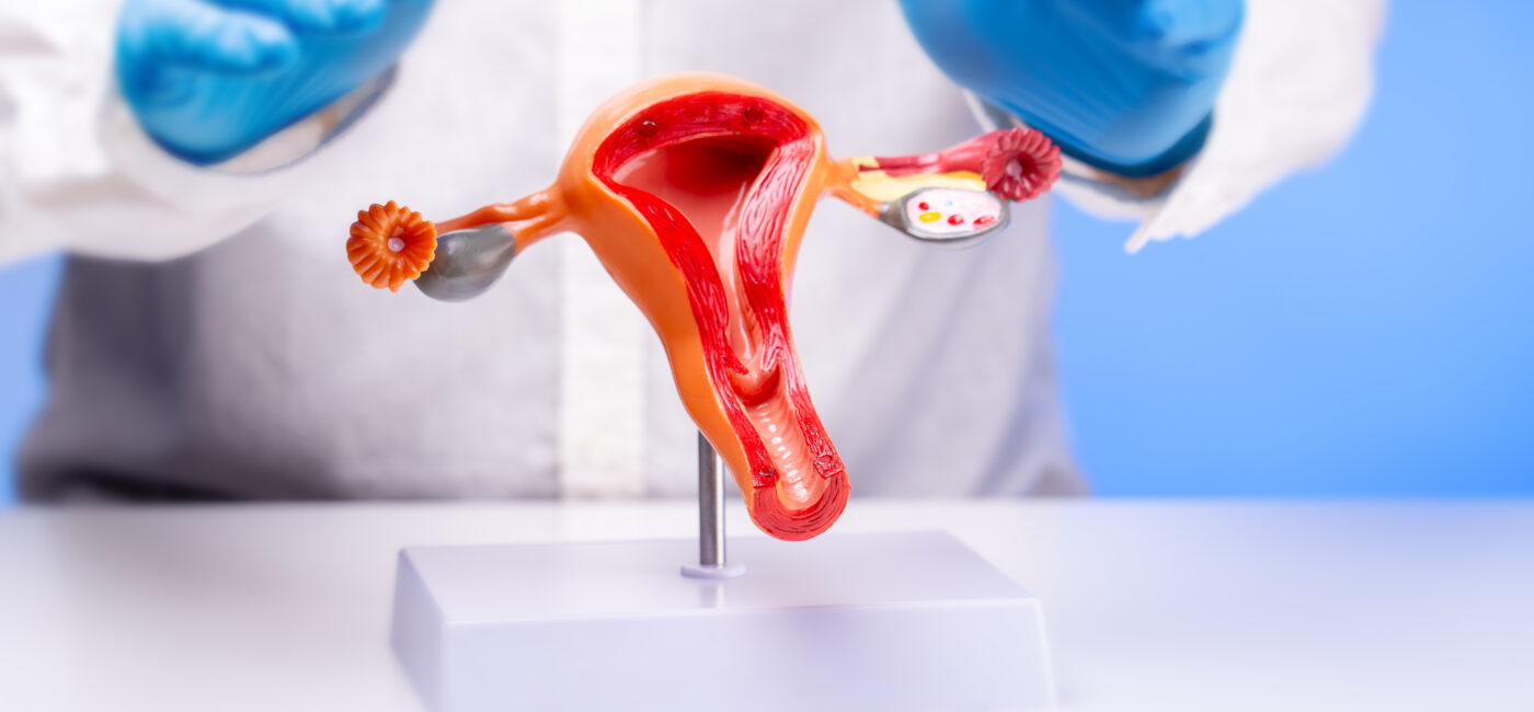 Deep Infiltrating Endometriosis: Symptoms, Diagnosis, and Treatment Options