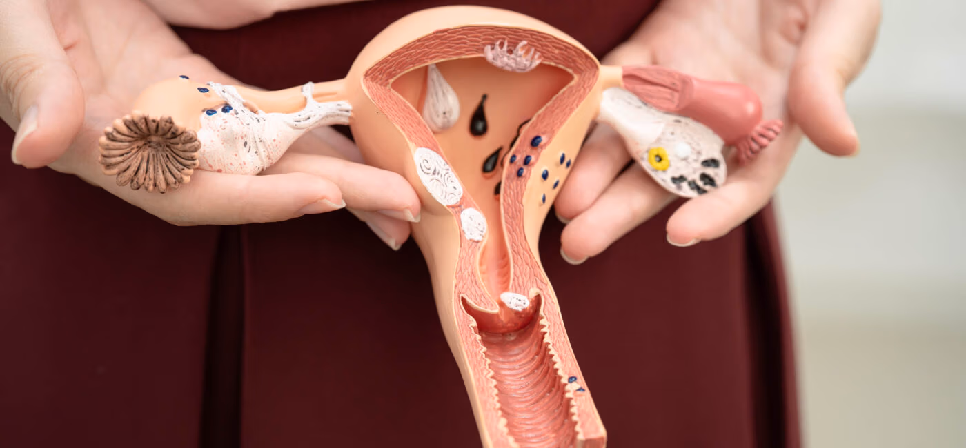 Endometrioma: Symptoms, Diagnosis, and Treatment Solutions