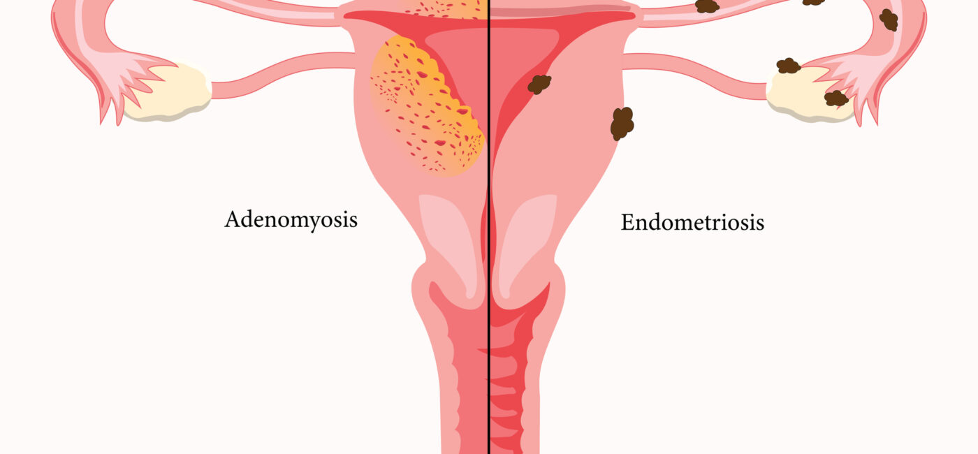Adenomyosis and Endometriosis: Two Diseases, One Patient