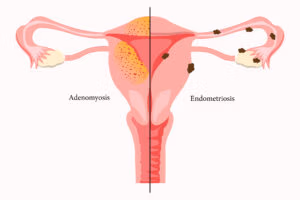 Adenomyosis and Endometriosis