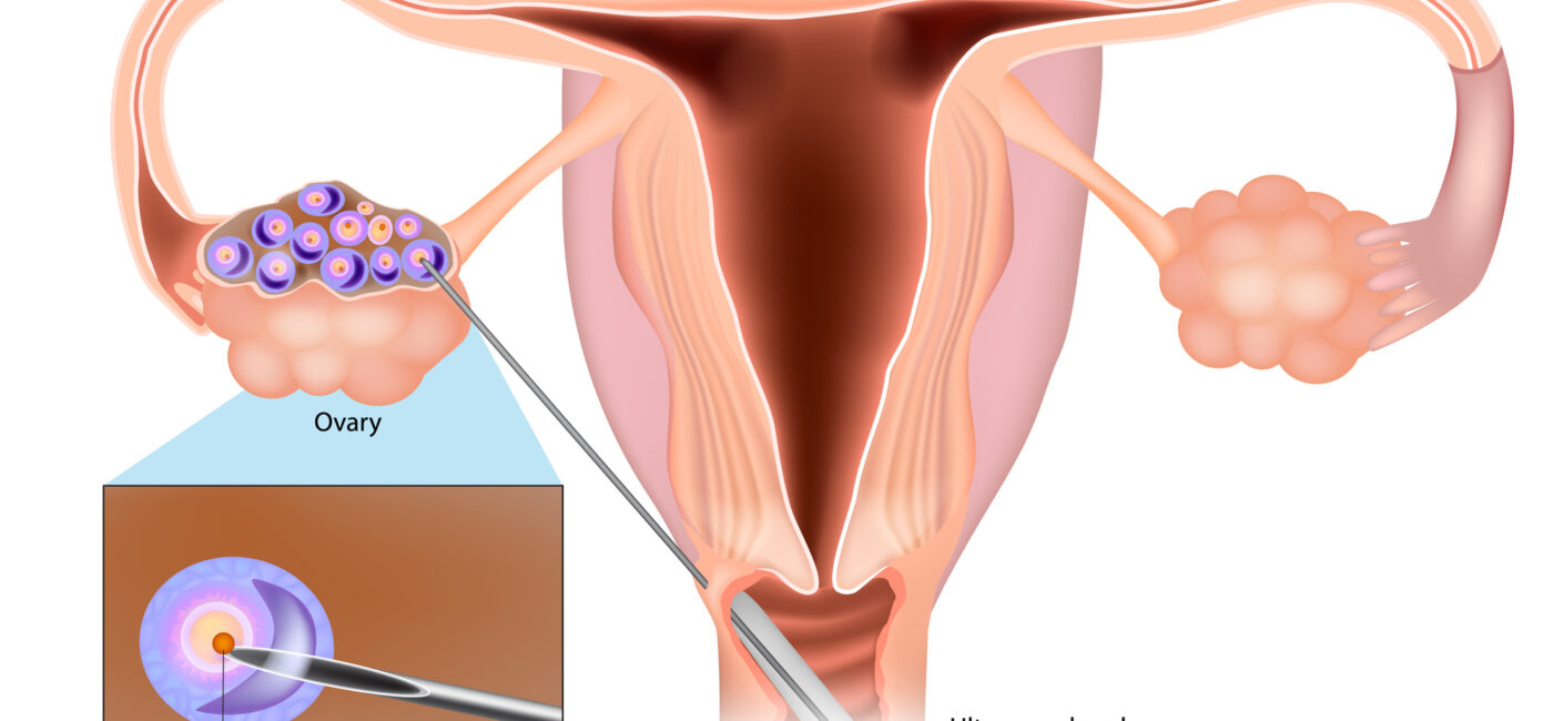 Egg Retrieval Before Endometrioma Surgery: What You Need to Know