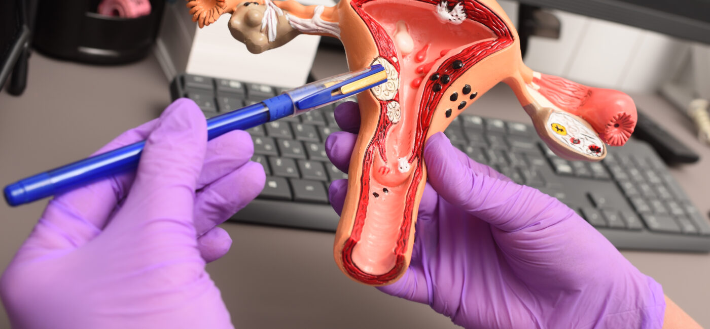 What Are Uterine Fibroids, and Could I Have Them?
